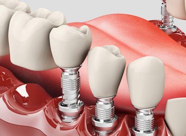 Evaluation of Fixed Denture Prosthetic Restorations with Pier Abutment